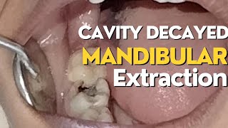 Cavity molar tooth extraction  molar extraction  cavity  tooth extraction [upl. by Solly]