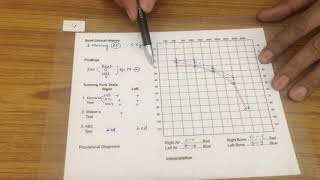 Common Audiograms in ENT [upl. by Llenral]