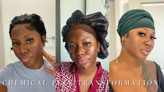 UNBELIEVABLE RESULTS OF MY CHEMICAL PEEL TRANSFORMATION [upl. by Itraa]