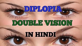 Double Vision  Diplopia In Hindi [upl. by Lance530]