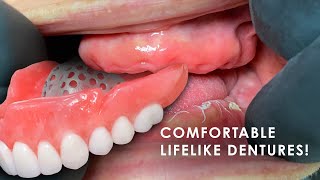 How to Create Comfortable Lifelike Dentures [upl. by Ardnekal]