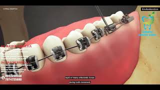 External Root Resorption Endodontics  Causes and Treatments by Bhartia Dental Clinic [upl. by Gearalt682]