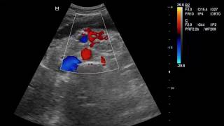 CASE 271 SUPERIOR MESENTERIC ARTERY SYNDROME SMAS [upl. by Gilbertine519]