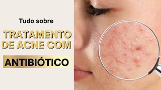 Tudo sobre tratamento de acne com antibiótico [upl. by Darwin934]