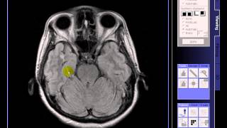 BRAIN MRI Multiple lacunar infarcts [upl. by Mckee]