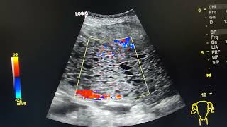 Complete hydatidiform mole with bilateral theca lutein cysts [upl. by Moretta]