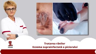 Tratarea ranilor 👉 Eczema suprainfectata a piciorului [upl. by Broddie]