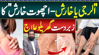 Scabies Home Treatment  Kharish Allergy Ka Ilaj  Psoriasis and Itching Treatment  Chambal Ka ilaj [upl. by Heyes575]