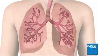 How an asthma attack occurs  Bupa Health [upl. by Singleton34]