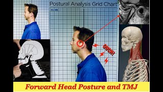 TMJ amp Forward Head Posture [upl. by Jann702]