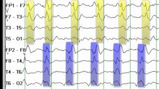 EEG Reading Rounds BIPLEDS [upl. by Ahsinauj]