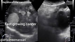 Liver cancer I Hepatic cancer I Hepatocellular carcinoma I Malignant hepatoma [upl. by Rafaellle]