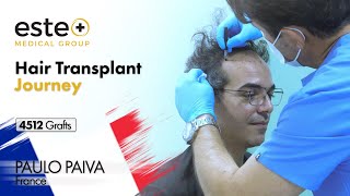 Turkey Hair Transplant Experience 4512 Grafts hairtransplantistanbul hairtransplantturkey [upl. by Nasho983]