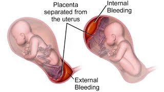 What is antepartum haemorrhage😷How to manage APHdrsaminakhurshidgynaecolog4661 [upl. by Ainnat]