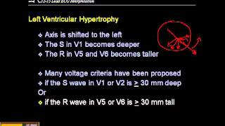 1215 Lead ECG Ventricular Hypertrophy [upl. by Clark]