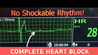 Third Degree AV Block  Complete Heart Block on Hospital Monitor cardiology [upl. by Raviv]