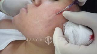 Subcision for Acne Scars  Acne Scar Treatment  Cheek Acne Scar Removal  Dr Jason Emer [upl. by Troc]