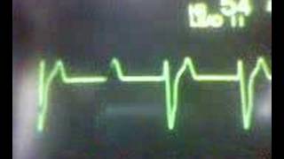 ECG Video Idioventricular Rhythm [upl. by Daly]