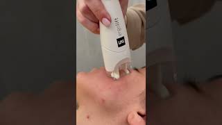 LPG Facial london skincare [upl. by Schaffel]