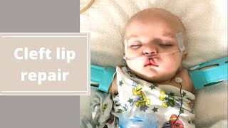 CLEFT LIP REPAIR Basic surgery and recovery information [upl. by Norabel946]