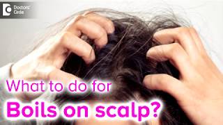 Boils On Scalp Filled With Pus Causes Treatment  Dr Rashmi Ravindra Doctors Circle [upl. by Hales]