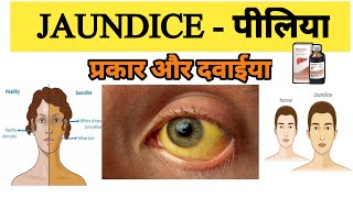 Jaundice treatment  Types of Jaundice  Symptoms of Jaundice  What is main cause of jaundice [upl. by Serles479]