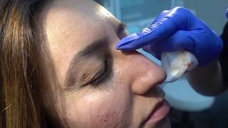 NonSurgical Nose Job NSNJ using Restylane [upl. by Hindu408]