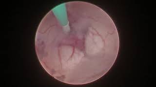 Endoscopic Third Ventriculostomy [upl. by Lucchesi]