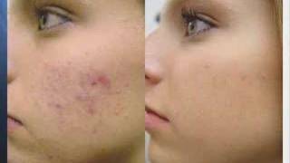 Acne Treatment with Fotona Laser [upl. by Setsero300]