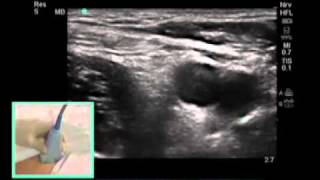 How To FEMORAL NERVE BLOCK  Dr Auyong Scanning Technique Video [upl. by Rhonda794]