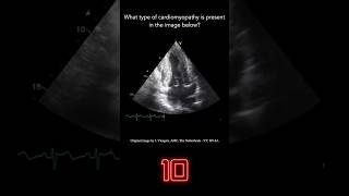 Echocardiography Question 4 [upl. by Nwahs828]