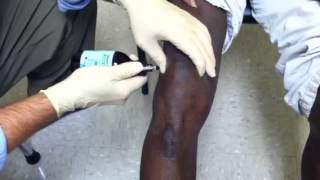 Steroid Knee Injection  Dr George Sutherland Bluffton SC [upl. by Clyde]