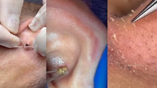 27 Minutes Of ASMR Pimple Popping Video [upl. by Files]