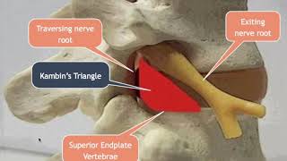 Lumbar Transforaminal Approach for Disc Herniations [upl. by Trilby490]