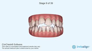 Invisalign Clincheck [upl. by Asiulairam655]