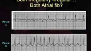 Intro EKG Interpretation Part 3 [upl. by Ayarahs513]