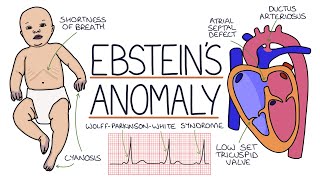 Understanding Ebsteins Anomaly [upl. by Nhguavaj]