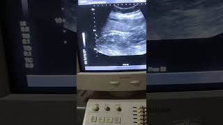 Bilateral nephrolithiasis with Right moderate Hydronephrosis by medical radiology [upl. by Infield]