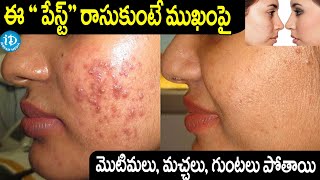 Remove Pimples and Acne Scars by  Face Pack  Dark Spots  IDream [upl. by Viking]