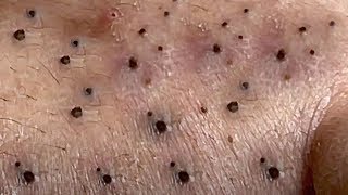 Blackheads Removal Big Acne blackheads Extraction Whiteheads [upl. by Eirffej]