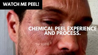 WATCH ME PEEL MY CHEMICAL PEEL EXPERIENCE AND PROCESS OF TCA ACID CHEMICAL PEEL [upl. by Alemap]