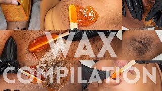 Waxing Marathon  Wax Compilation  Hirsutism  Leg  Underarm 20 MINUTES [upl. by Russia]