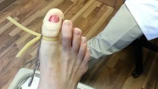 Permanent toenail removal in less than 4 minutes [upl. by Quiteria]