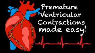 EMS Cardiology  Tachy Tuesday Premature Ventricular Contractions PVC [upl. by Anais]