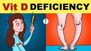 Vitamin D Deficiency  Vitamin D Deficiency Symptoms  Vitamin D Deficiency Rickets  Osteomalacia [upl. by Acenahs]