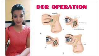 Dacryocystorhinostomy DCRsurgery Dacryocystitis Part 2 A K Khurana [upl. by Kiyoshi]