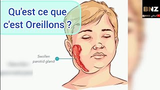 Oreillons  définition  Transmission  Complication  Symptômes et Traitement 😀 [upl. by Kappel]