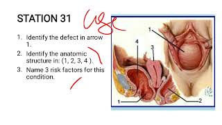 Cystocele Case Study [upl. by Anavi]