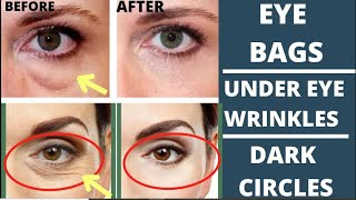 🛑 FACE YOGA FOR EYE WRINKLES  DARK CIRCLES  EYE BAGS  PUFFY EYES  TIGHTEN DROOPY EYELIDS [upl. by Etnoel]