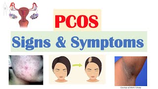 Polycystic Ovary Syndrome PCOS Signs amp Symptoms  amp Why They Occur [upl. by Phiona]